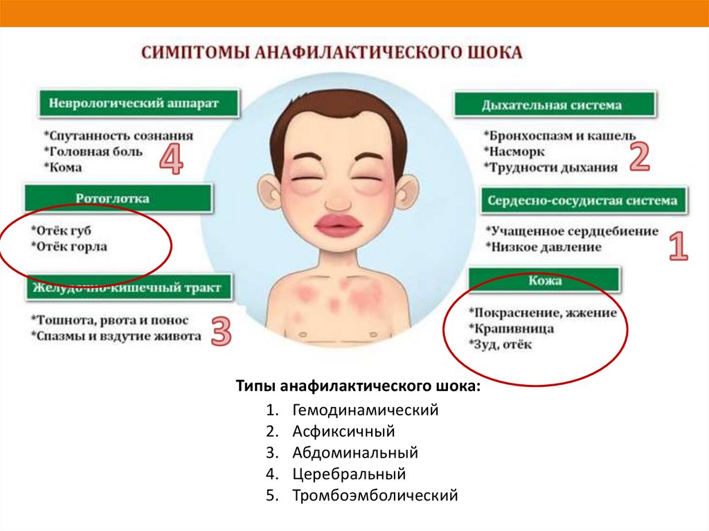 Чем обработать ожог от крапивы?