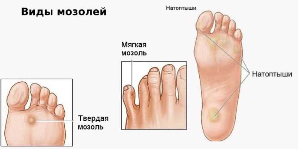 Мозоли и натоптыши