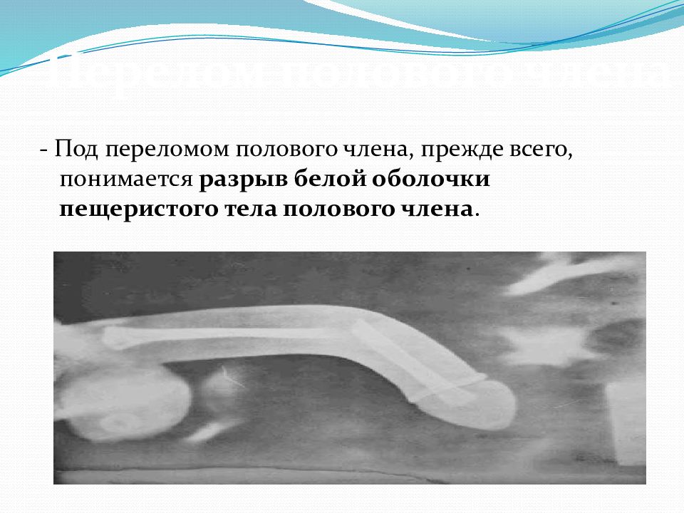 Можно ли сломать пенис, занимаясь сексом: что такое перелом полового члена и когда он возможен, мнение врачей