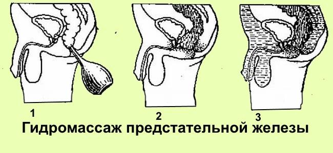 Массаж простаты