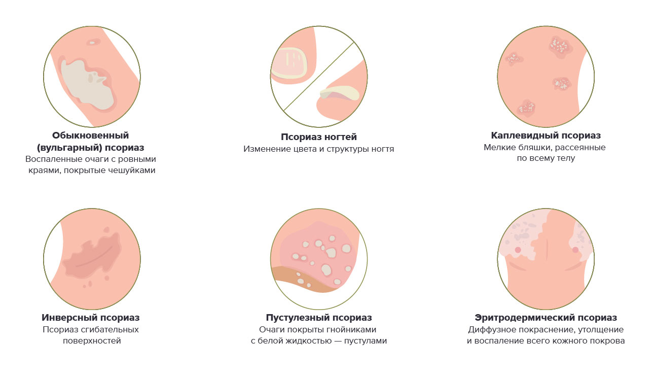 Мифы и правда об атопическом дерматите