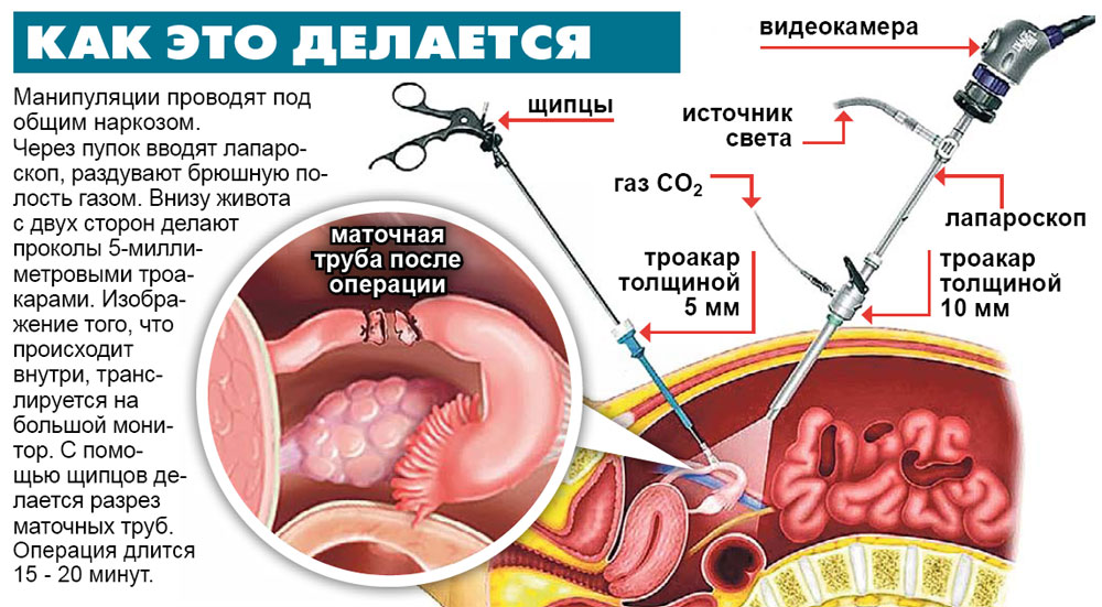 Стерилизация... девочки, кому делали, может есть знакомые, кому делали, не проходите мимо!!! - страна мам