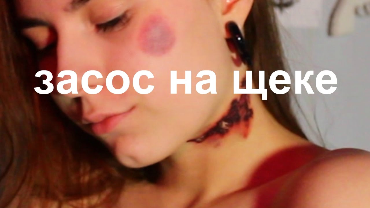 Как убрать засос: 7 самых эффективных и доступных способов