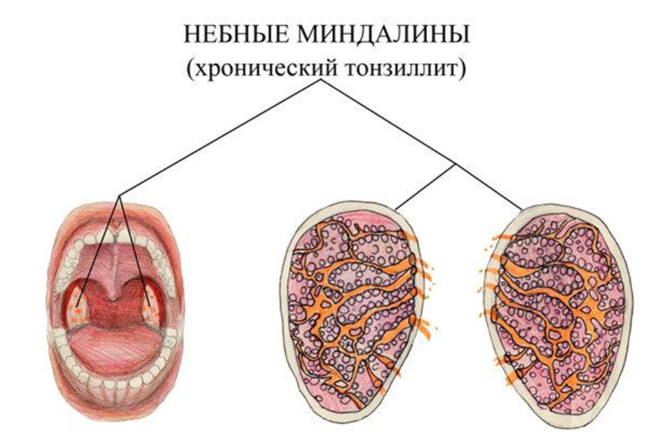 Тонзиллит: симптомы, чем и как лечить тонзиллит в горле у взрослого