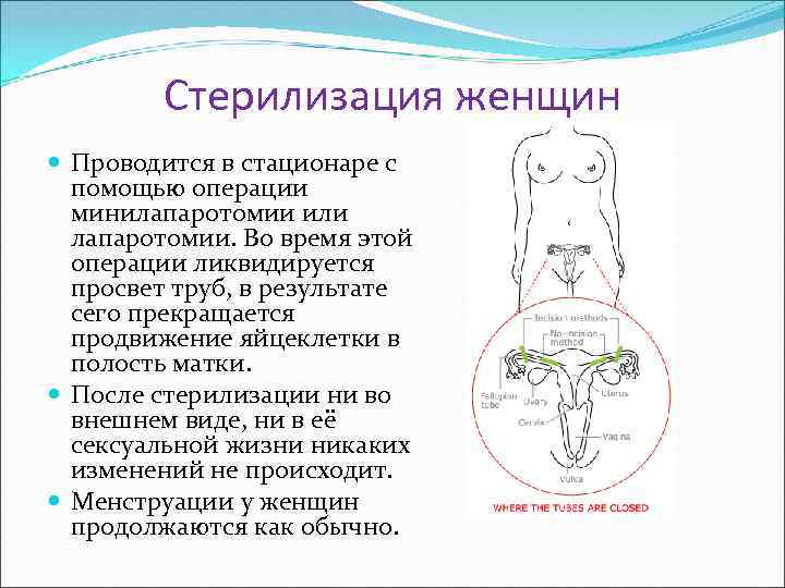 Стерилизация женщины, перевязка маточных труб: как происходит, как делают, плюсы и минусы, последствия