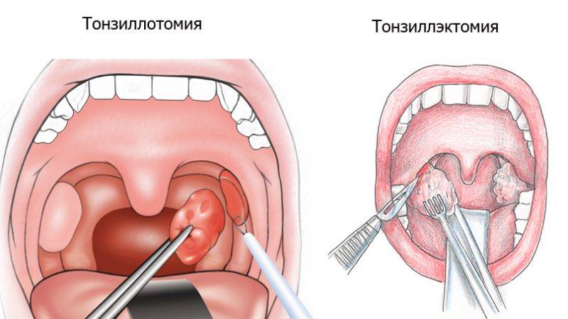 Казеозные пробки в горле - причины, лечение у детей и взрослых
