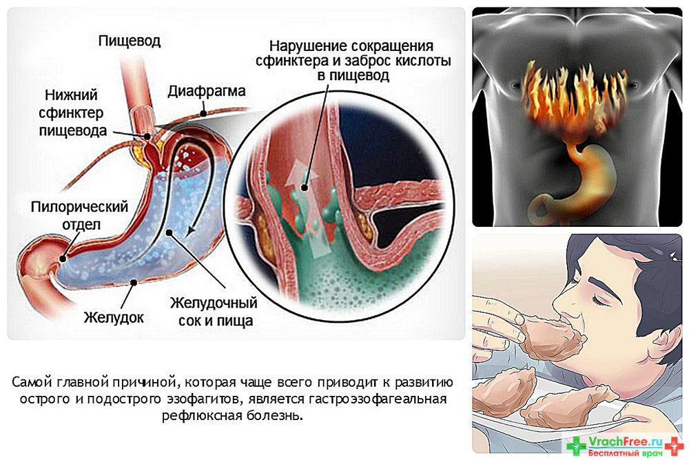 Сильная изжога: причины, методы лечения и профилактика