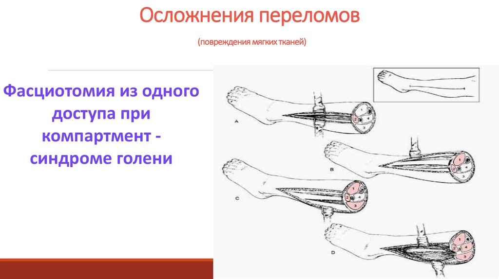 Перелом полового члена: особенности, диагностика, лечение