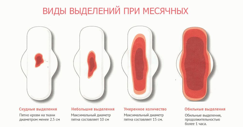 Гиперменструальный синдром: обильные месячные | университетская клиника