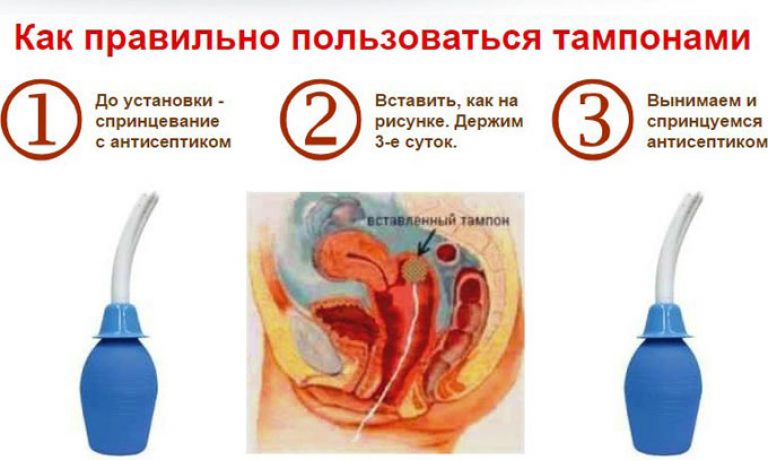 Тампоны или прокладки...