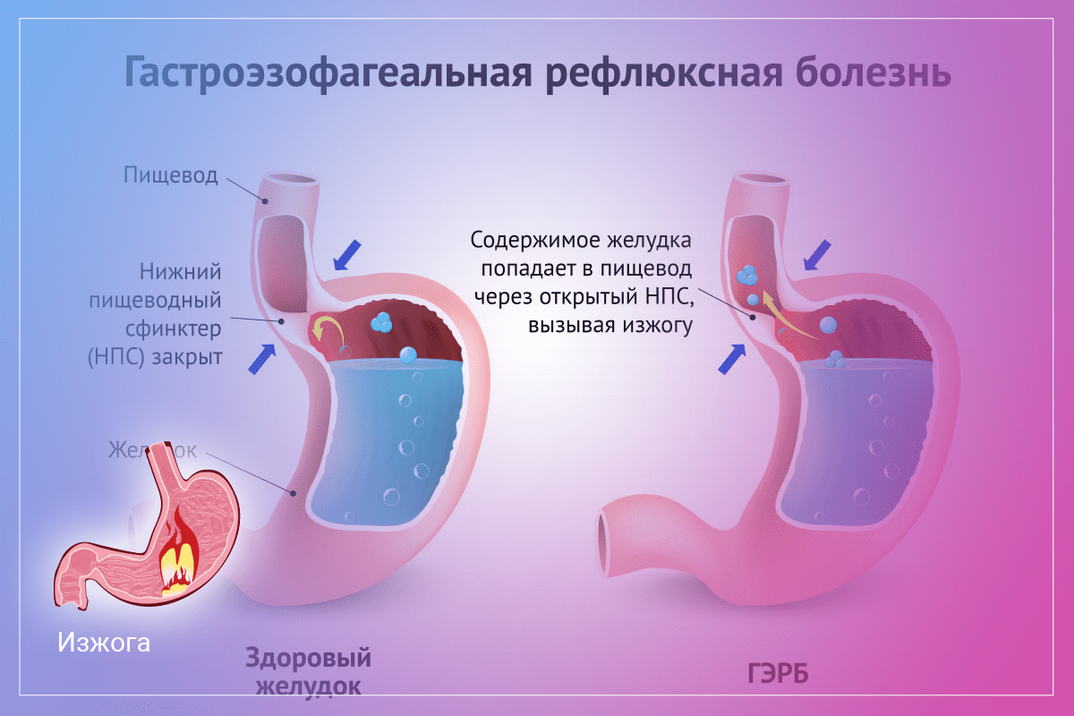 Как избавиться от изжоги при беременности: народные средства и диета при изжоге у беременных