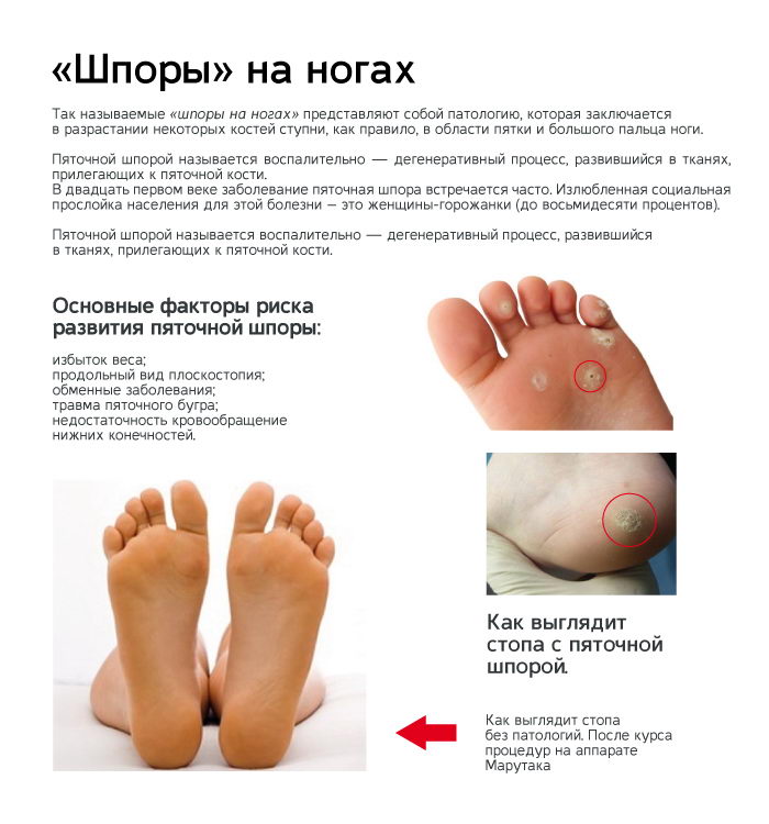 8 способов избавиться от мозолей в домашних условиях