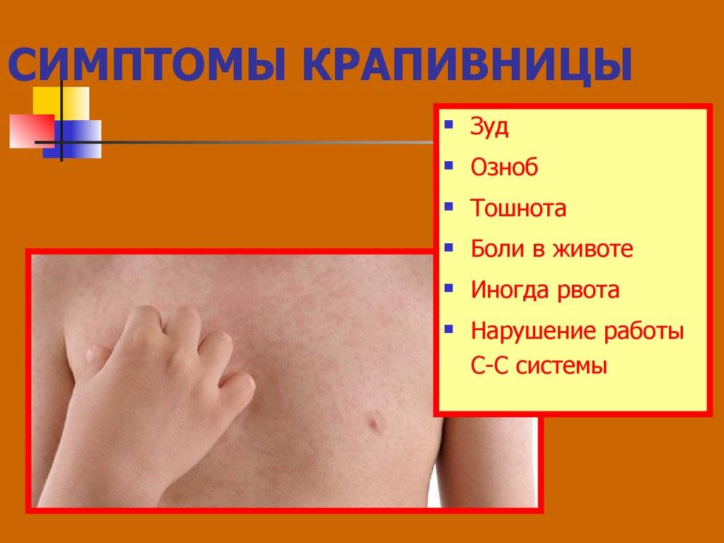 Ожог крапивой: что делать, лечение и польза