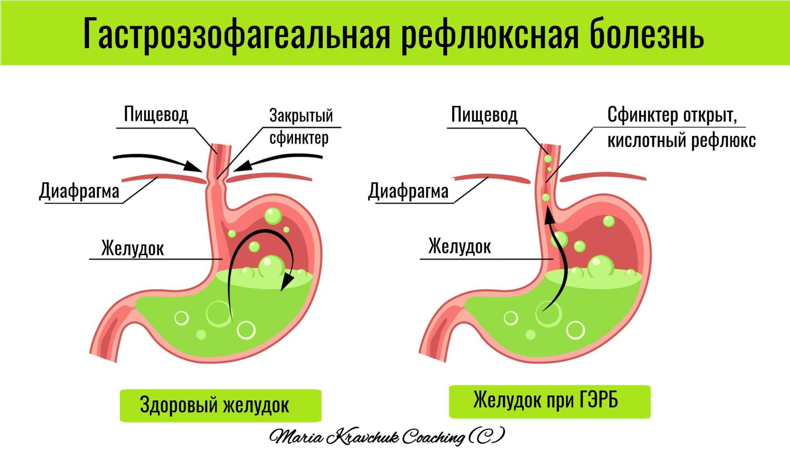 Изжога и кислая отрыжка - причины, что делать в случае появления, методы профилактики | статьи – омез 10 мг