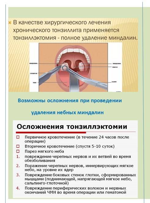 Удаление миндалин: надо или нет, причины, виды операций, восстановление после удаления, за и против | азбука здоровья