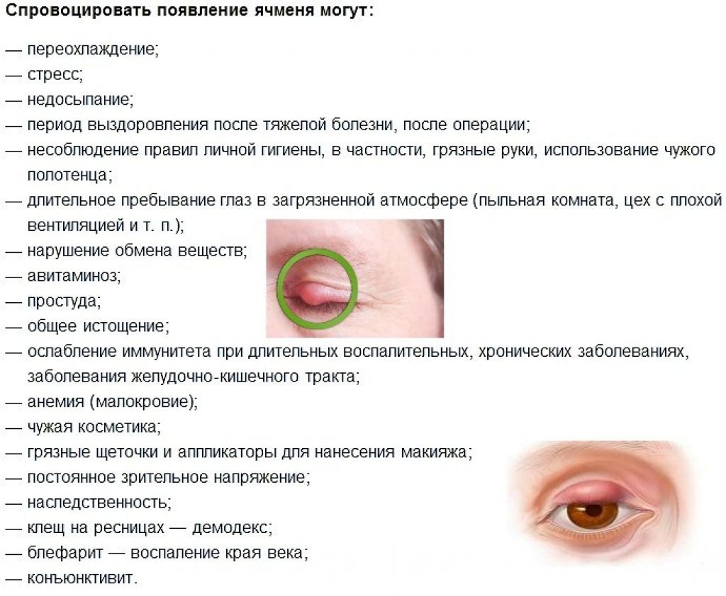 Как лечить ячмень на глазу дома: капли, мази, народные средства