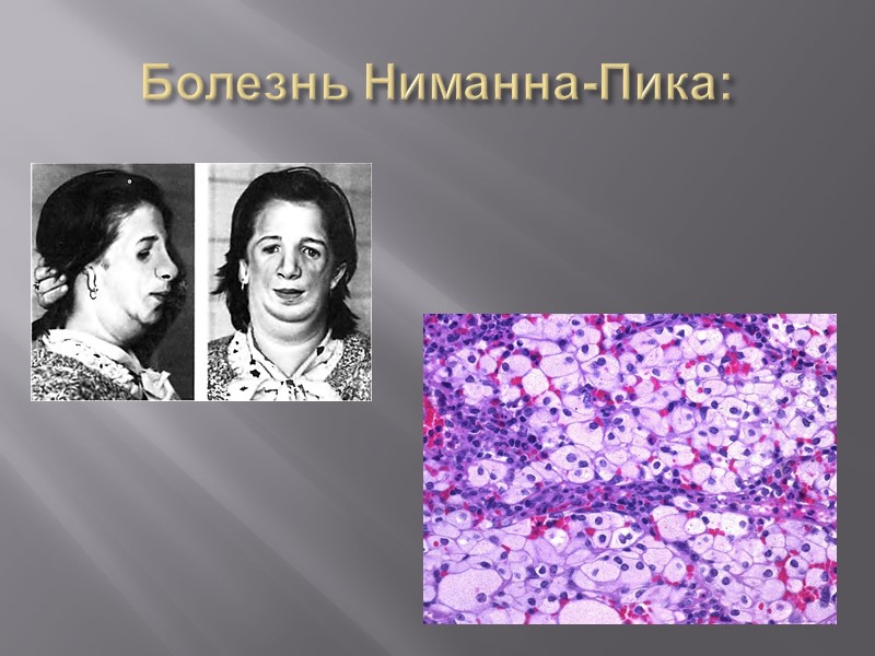 Наследственное ожирение: синдром прадера — вилли