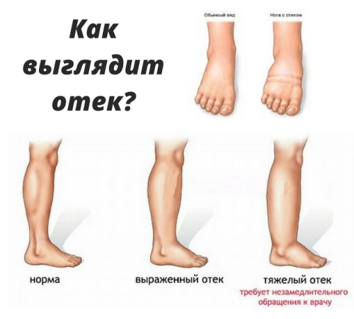 Причины отекшего лица у женщин и мужчин - почему оно сильно опухает, и от чего постоянно появляются отеки и одутловатость