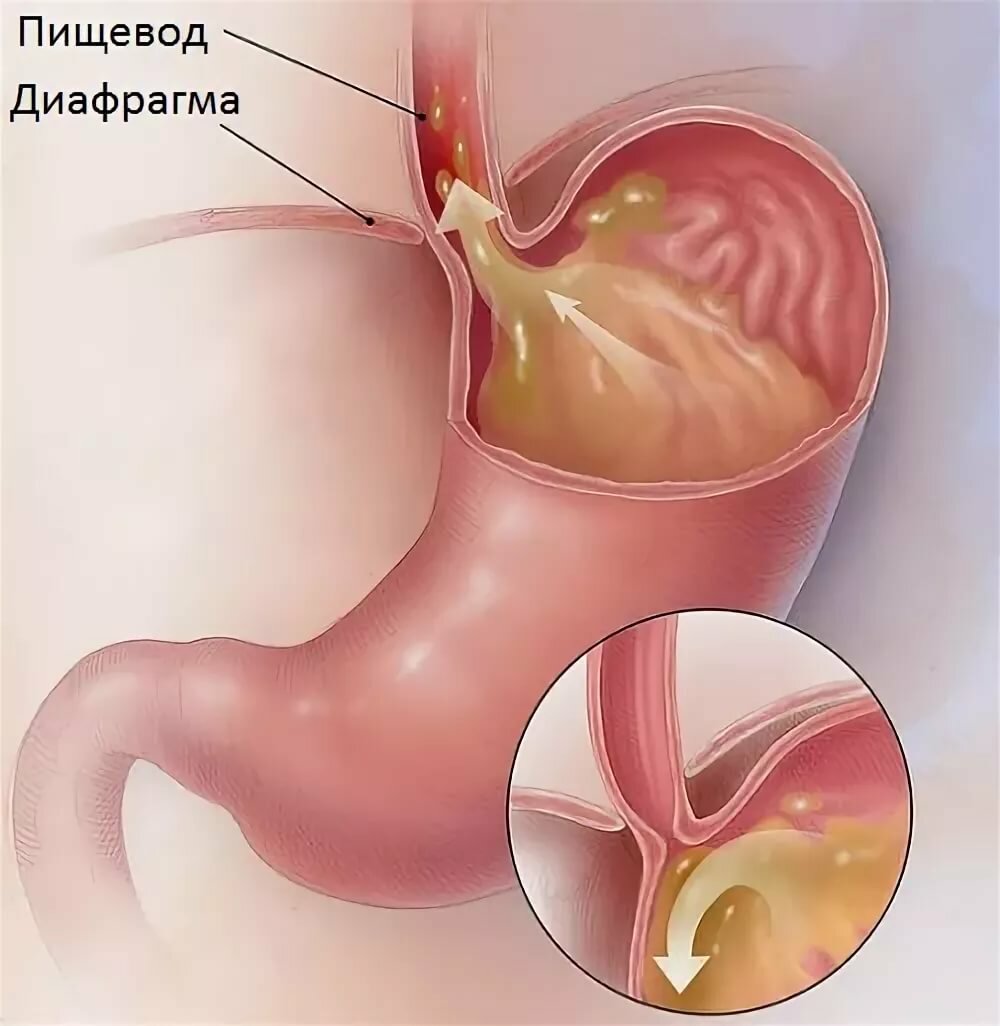 Как без лекарств и таблеток избавиться от изжоги?