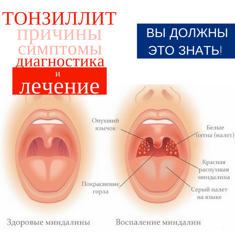 Тонзиллит камень: удаление пробок из миндалин, как убрать, чем лечить